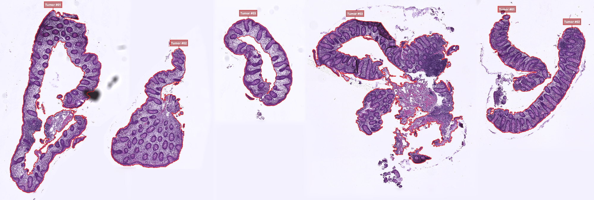 segmented colon tumor